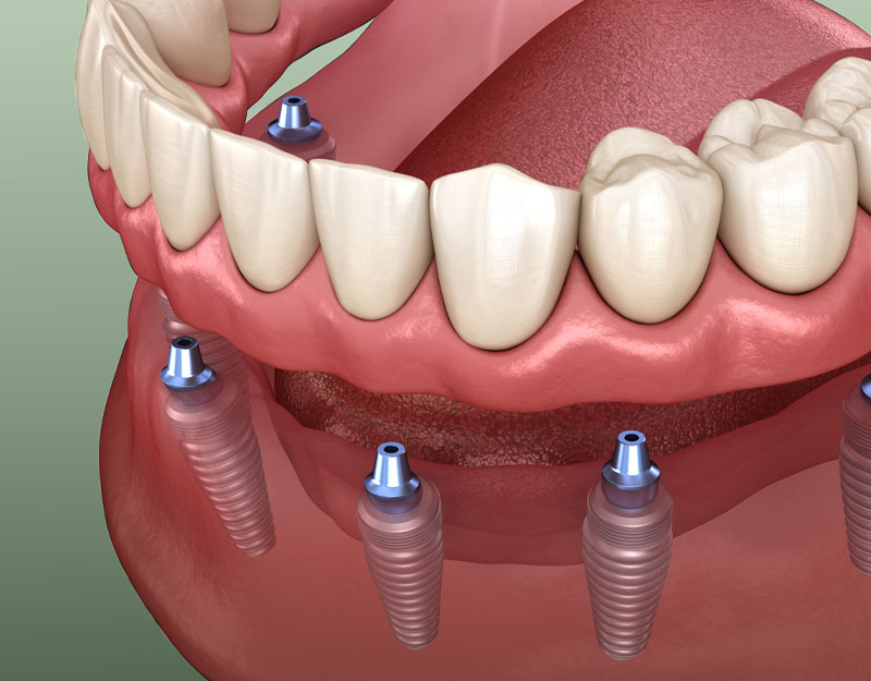 implant supported dentures model Waterford, CT