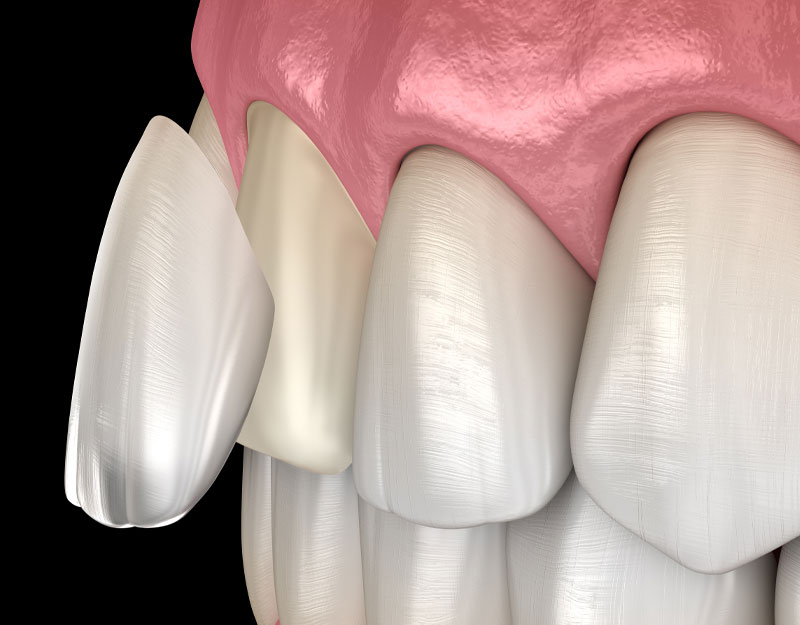 porcelain veneer Waterford, CT