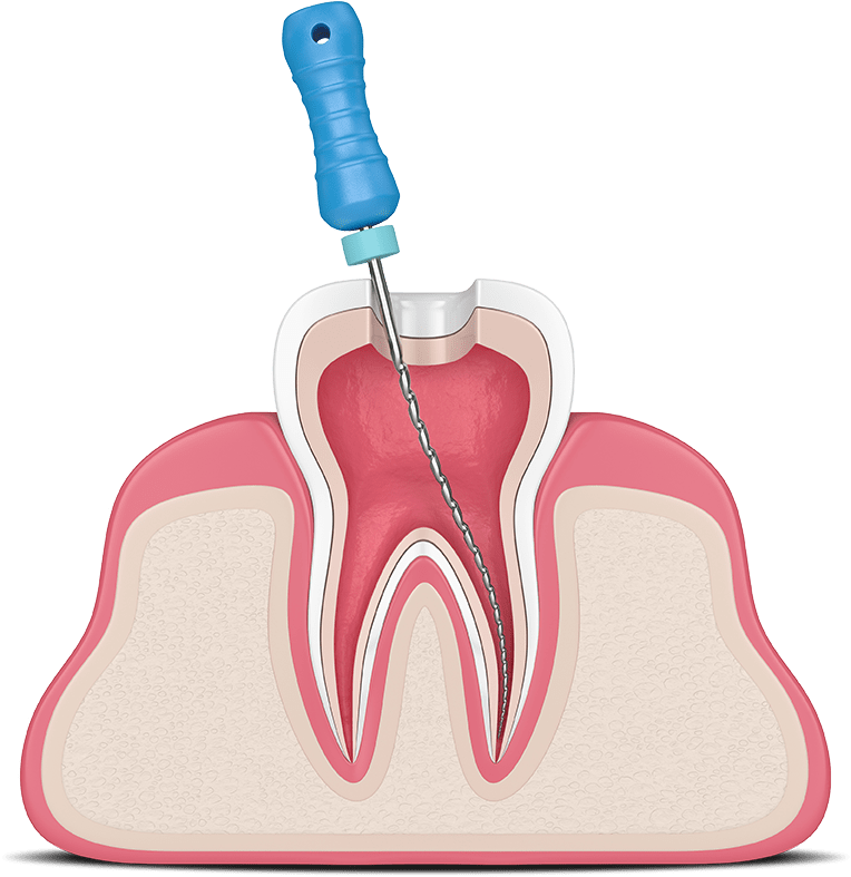 root canal graphic Waterford, CT